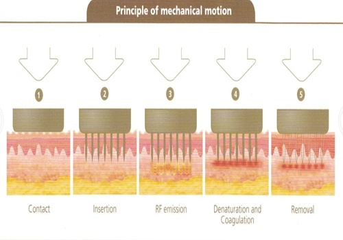 Аппарат микроигольчатого RF лифтинга Dermatrix DUO (GSD) фото 6