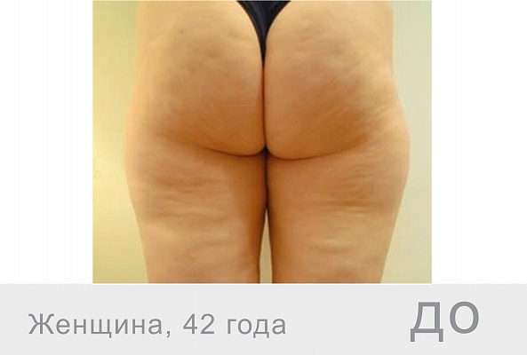 F-XBC Body Комплекс для тела, 10мл фото 2