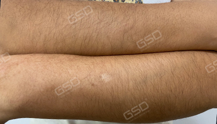 Диодный лазер COOLITE BOLT 1800W фото 10